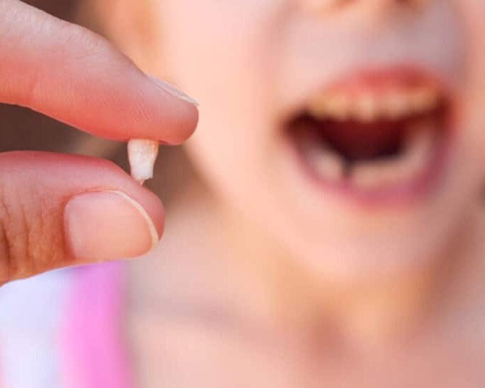 dientes de leche caída
