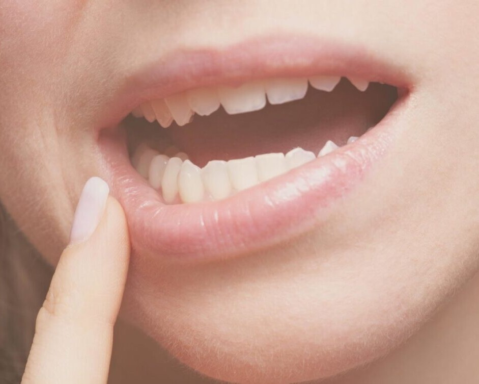 dientes astillados